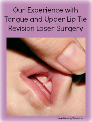 Our Experience with Tongue and Upper Lip Tie Revision Laser Surgery   BreastfeedingPlace.com  #liptie #surgery #breastfeeding